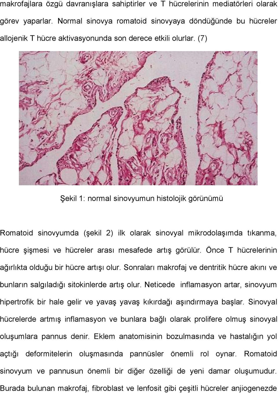 (7) Şekil 1: normal sinovyumun histolojik görünümü Romatoid sinovyumda (şekil 2) ilk olarak sinovyal mikrodolaşımda tıkanma, hücre şişmesi ve hücreler arası mesafede artış görülür.