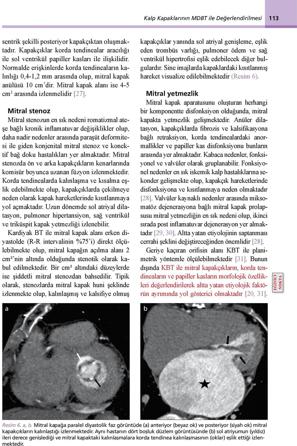 Mitrl stenoz Mitrl stenozun en sık nedeni romtizml teşe ğlı kronik inflmtuvr değişiklikler olup, dh ndir nedenler rsınd prşüt deformitesi ile giden konjenitl mitrl stenoz ve konektif ğ doku hstlıklrı