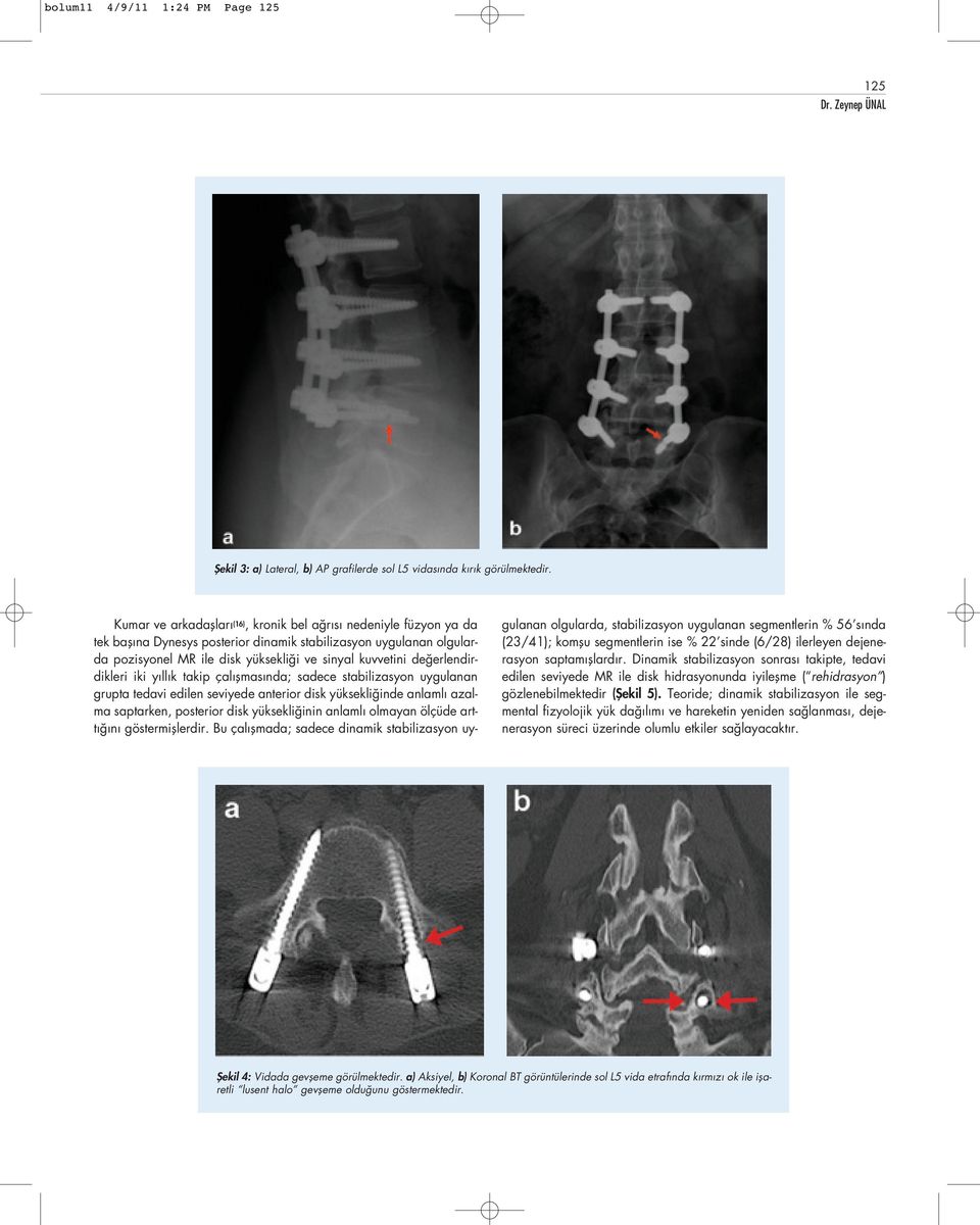 posterior disk yüksekli inin anlaml olmayan ölçüde artt n göstermifllerdir. Bu çal flmada; sadece dinamik stabilizasyon uyfiekil 3: a) Lateral, b) AP grafilerde sol L5 vidas nda k r k görülmektedir.