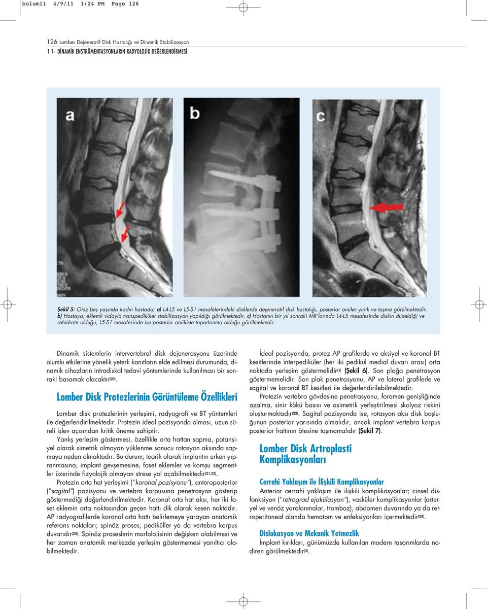 c) Hastan n bir y l sonraki MR lar nda L4-L5 mesafesinde diskin düzeldi i ve rehidrate oldu u, L5-S1 mesafesinde ise posterior anülüste toparlanma oldu u görülmektedir.