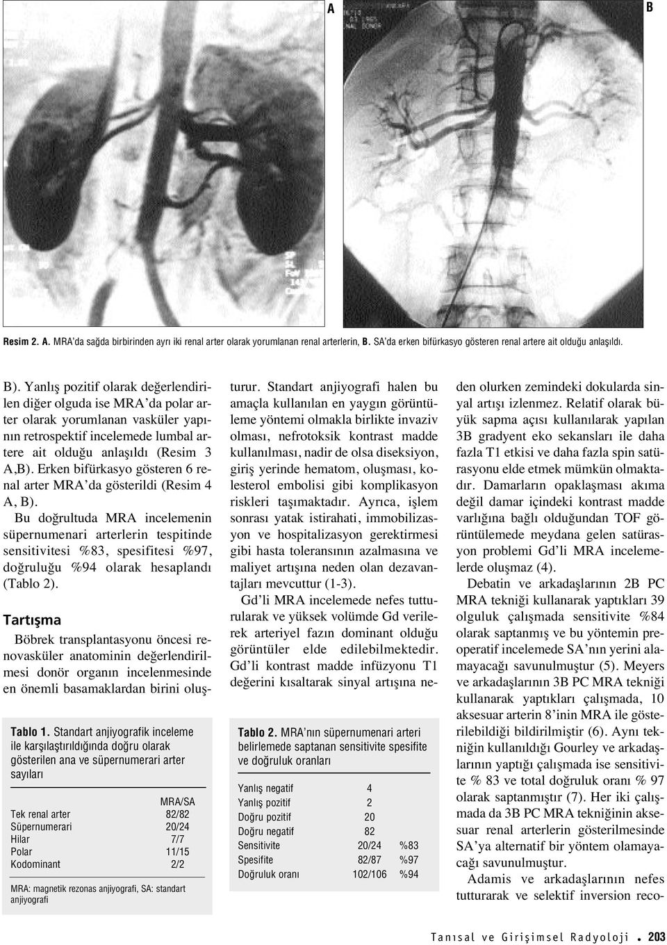 Erken bifürkasyo gösteren 6 renal arter MRA da gösterildi (Resim 4 A, ).