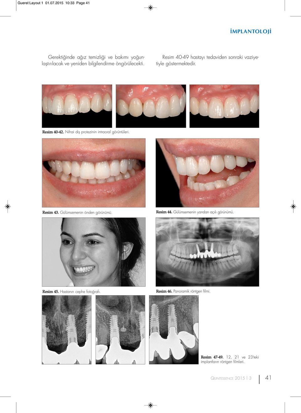 Resim 40-49 hastayı tedaviden sonraki vaziyetiyle göstermektedir. Resim 40-42. Nihai diş protezinin intraoral görüntüleri.