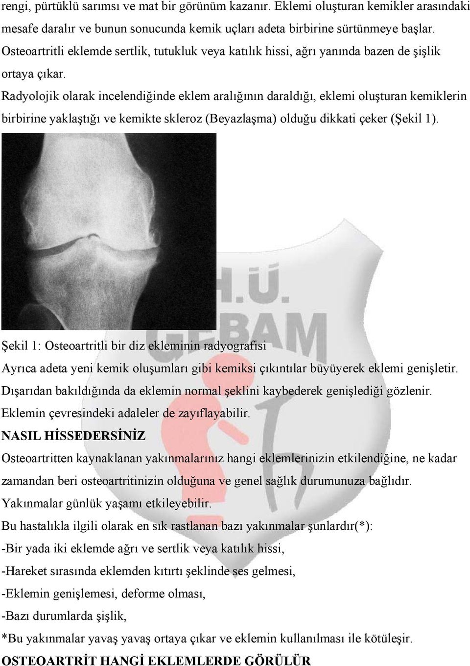 Radyolojik olarak incelendiğinde eklem aralığının daraldığı, eklemi oluşturan kemiklerin birbirine yaklaştığı ve kemikte skleroz (Beyazlaşma) olduğu dikkati çeker (Şekil 1).