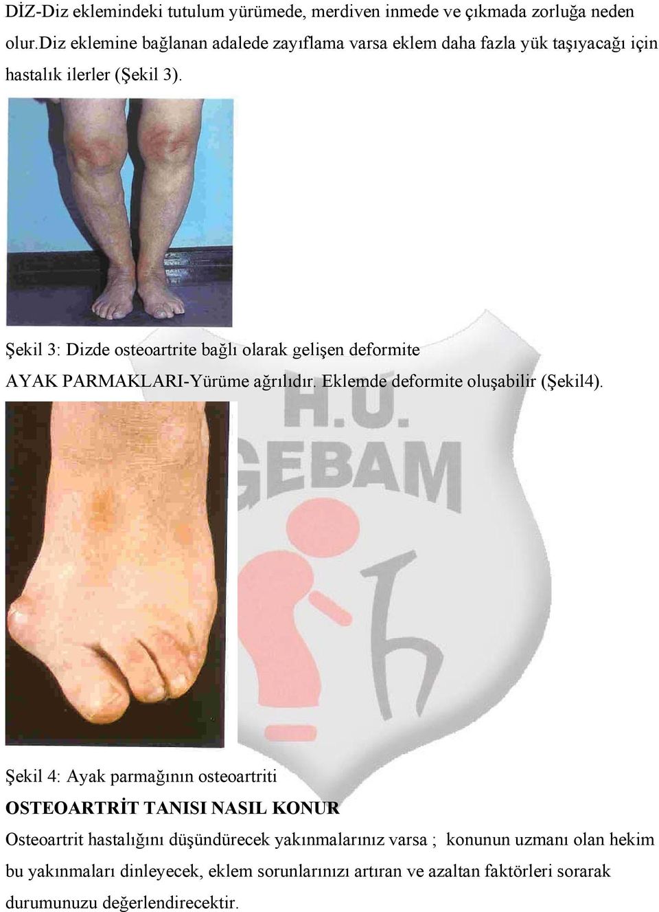 Şekil 3: Dizde osteoartrite bağlı olarak gelişen deformite AYAK PARMAKLARI-Yürüme ağrılıdır. Eklemde deformite oluşabilir (Şekil4).