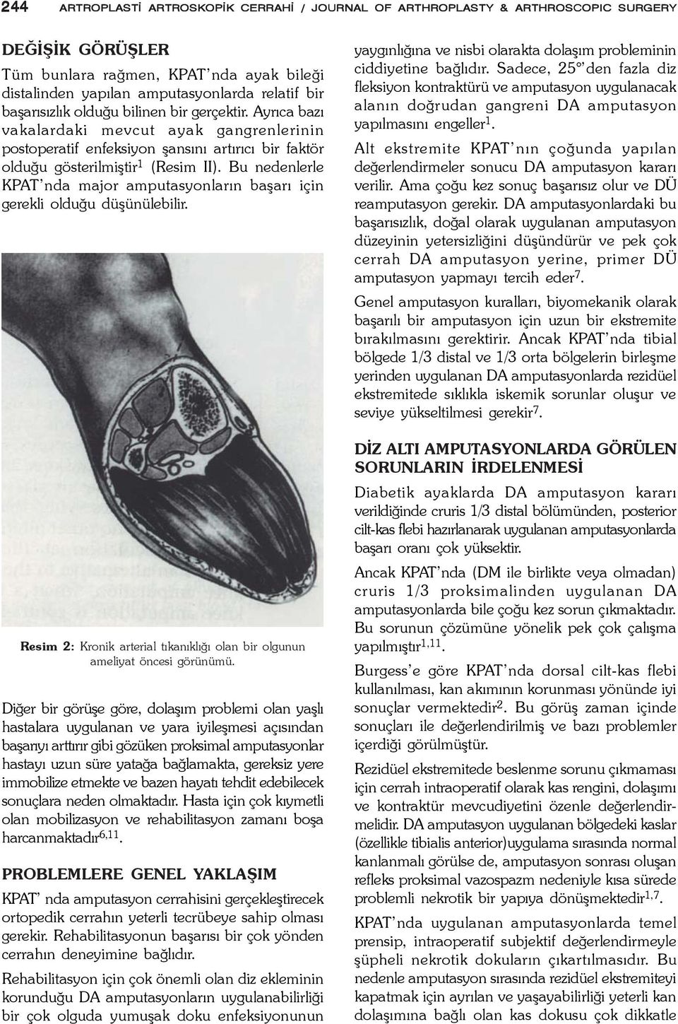 Bu nedenlerle KPAT nda major amputasyonlarýn baþarý için gerekli olduðu düþünülebilir. Resim 2: Kronik arterial týkanýklýðý olan bir olgunun ameliyat öncesi görünümü.