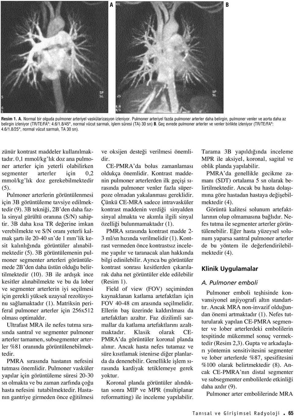 zünür kontrast maddeler kullan lmaktad r. 0,1 mmol/kg l k doz ana pulmoner arterler için yeterli olabilirken segmenter arterler için 0,2 mmol/kg l k doz gerekebilmektedir (5).