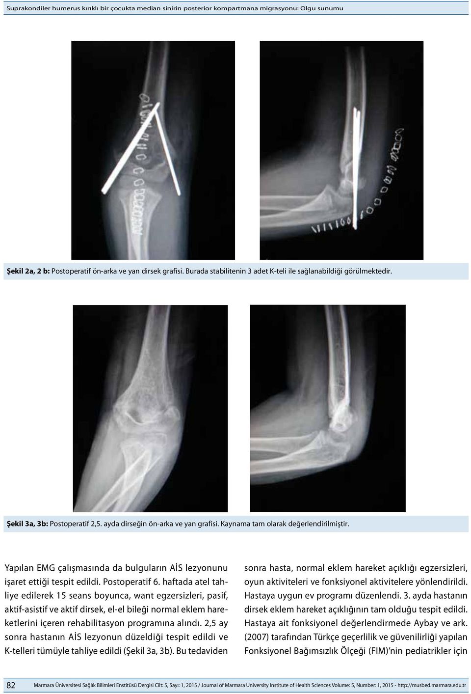 Yapılan EMG çalışmasında da bulguların AİS lezyonunu işaret ettiği tespit edildi. Postoperatif 6.