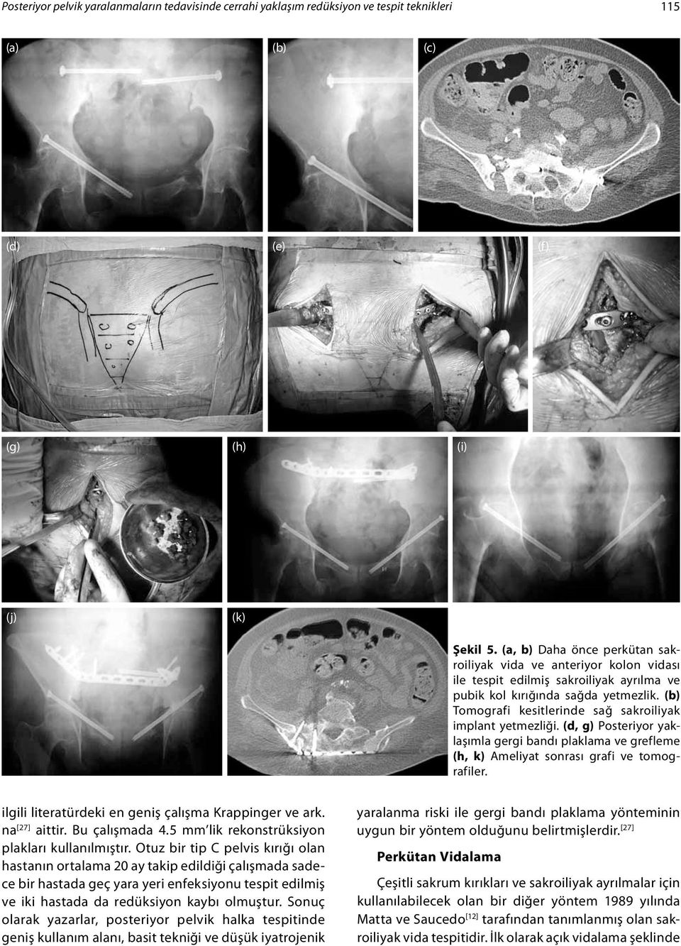 (b) Tomografi kesitlerinde sağ sakroiliyak implant yetmezliği. (d, g) Posteriyor yaklaşımla gergi bandı plaklama ve grefleme (h, k) Ameliyat sonrası grafi ve tomografiler.