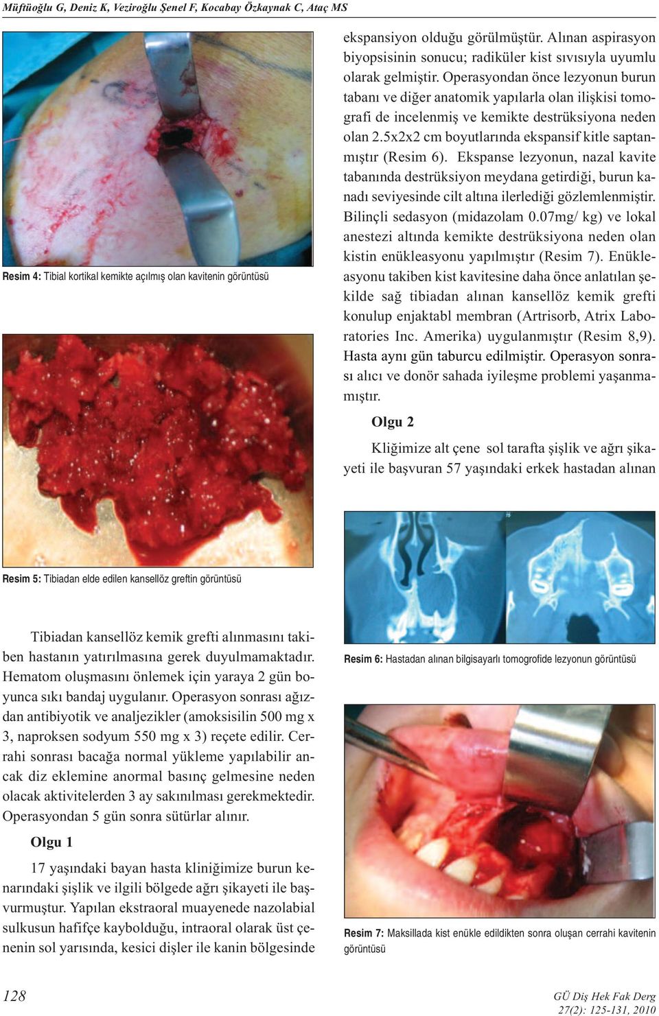 Operasyondan önce lezyonun burun tabanı ve diğer anatomik yapılarla olan ilişkisi tomografi de incelenmiş ve kemikte destrüksiyona neden olan 2.