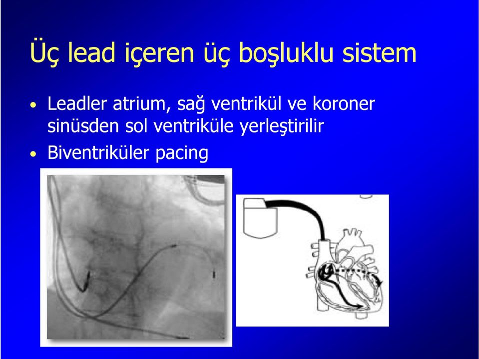 koroner sinüsden sol ventriküle