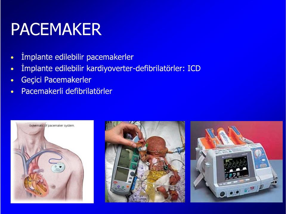 kardiyoverter-defibrilatörler