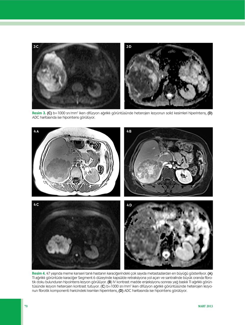 (A) T1 a rl kl görüntüde karaci er Segment 6 düzeyinde kapsülde retraksiyona yol açan ve santralinde büyük oranda fibrotik doku bulunduran hipointens lezyon görülüyor.