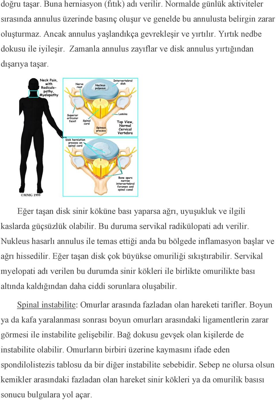 Eğer taşan disk sinir köküne bası yaparsa ağrı, uyuşukluk ve ilgili kaslarda güçsüzlük olabilir. Bu duruma servikal radikülopati adı verilir.