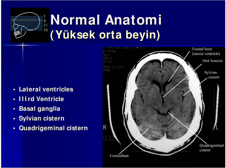 IIIrd Ventricle Basal ganglia