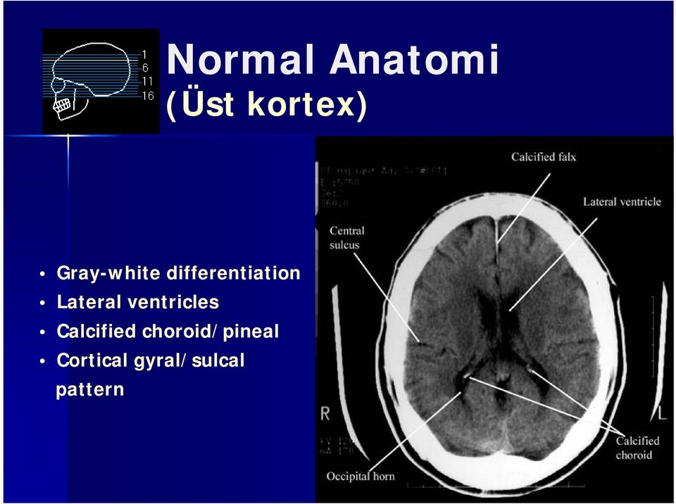 Lateral ventricles Calcified