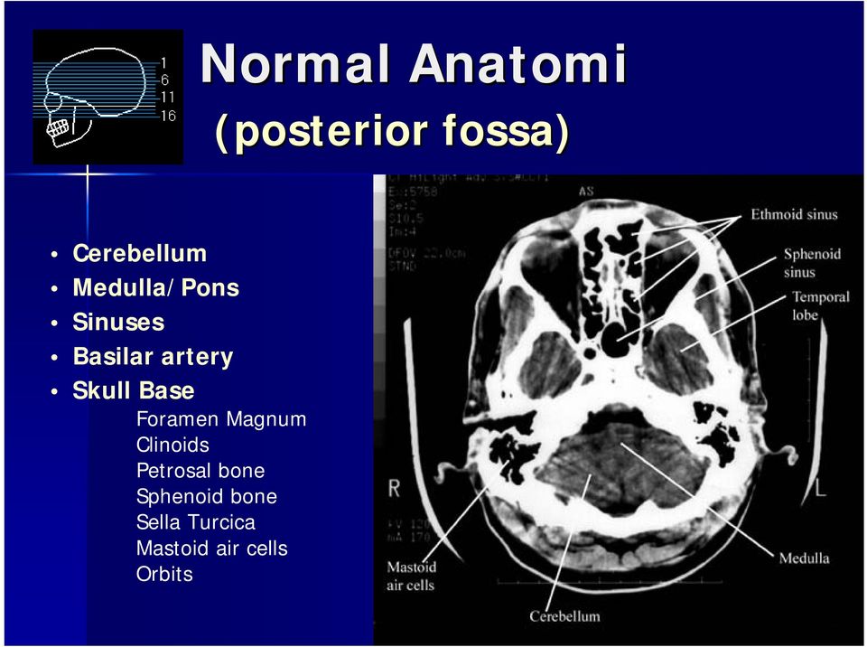 Foramen Magnum Clinoids Petrosal bone