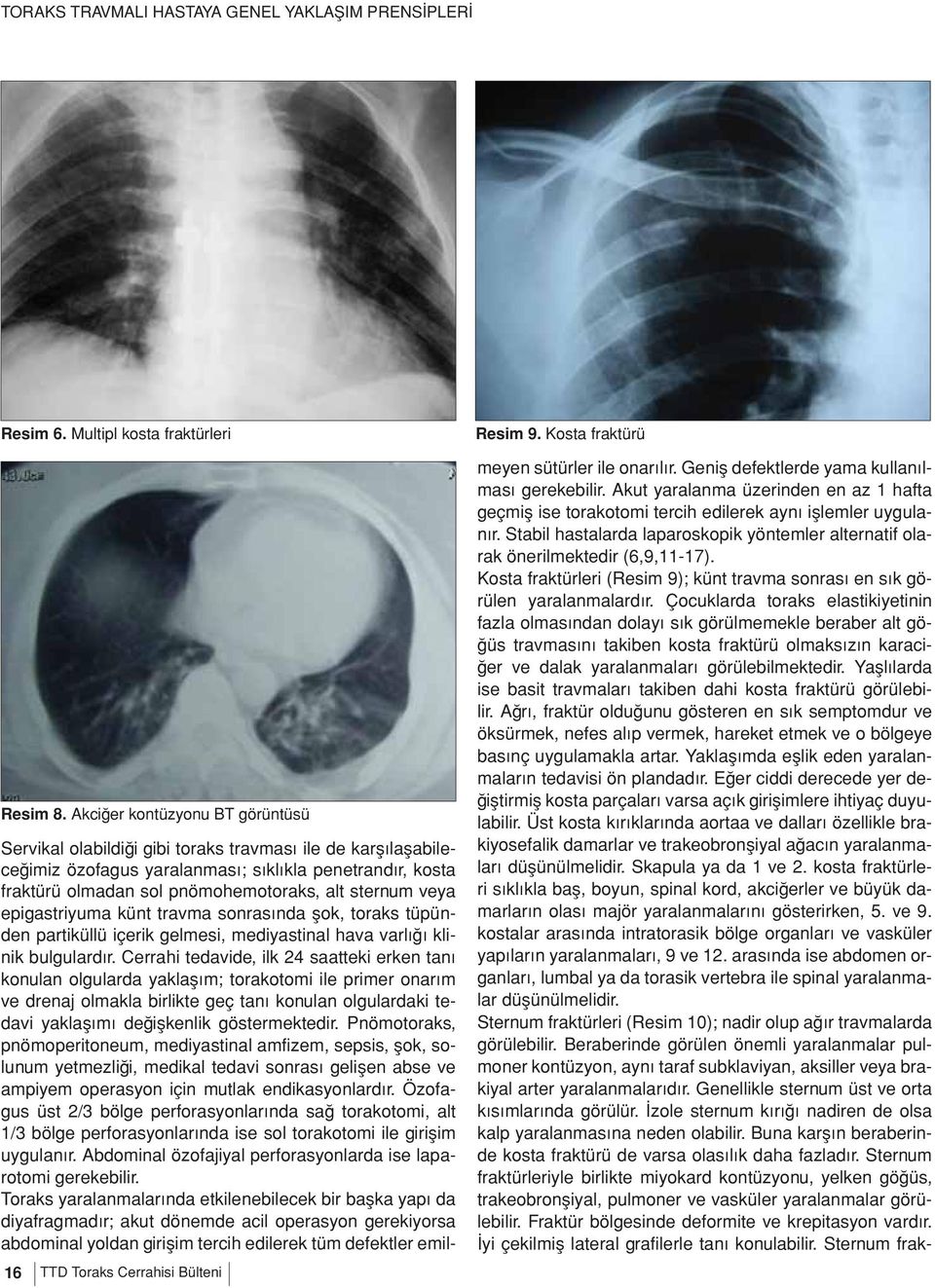 epigastriyuma künt travma sonrasında şok, toraks tüpünden partiküllü içerik gelmesi, mediyastinal hava varlığı klinik bulgulardır.