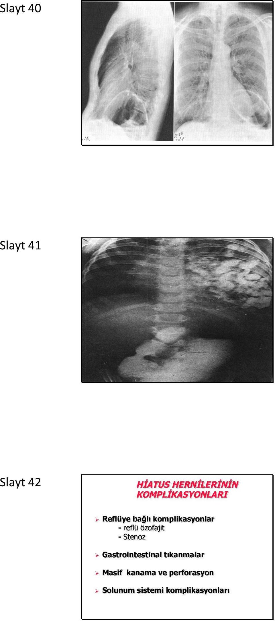 reflü özofajit - Stenoz Gastrointestinal tıkanmalar