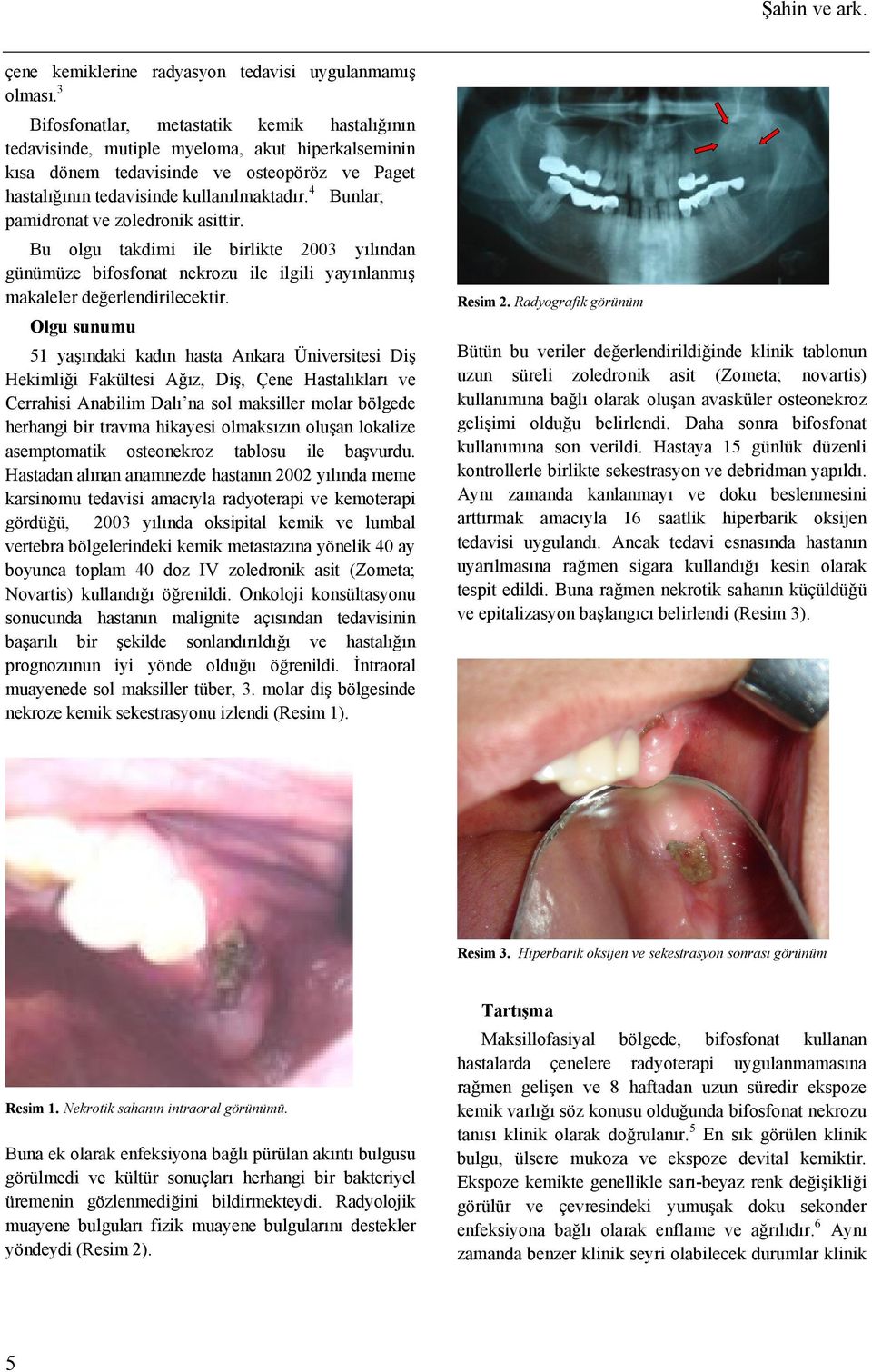 kullanılmaktadır. 4 Bunlar; pamidronat ve zoledronik asittir. Bu olgu takdimi ile birlikte 2003 yılından günümüze bifosfonat nekrozu ile ilgili yayınlanmış makaleler değerlendirilecektir.