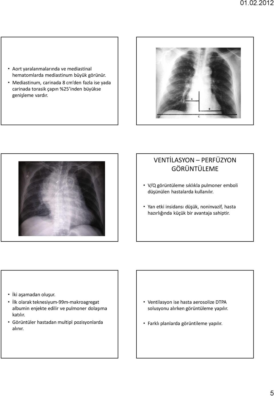 25 26 VENTİLASYON PERFÜZYON GÖRÜNTÜLEME V/Q görüntüleme sıklıkla pulmoner emboli düşünülen hastalarda kullanılır.