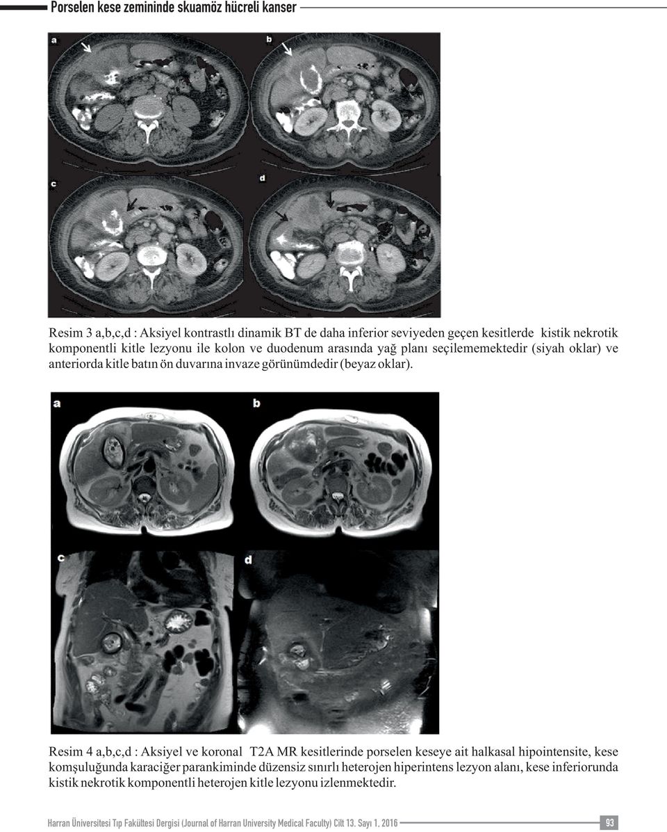 Resim 4 a,b,c,d : Aksiyel ve koronal T2A MR kesitlerinde porselen keseye ait halkasal hipointensite, kese komşuluğunda karaciğer parankiminde düzensiz sınırlı