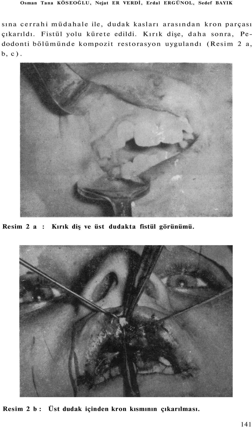 Kırık dişe, daha sonra, Pedodonti bölümünde kompozit restorasyon uygulandı (Resim 2 a, b, c).