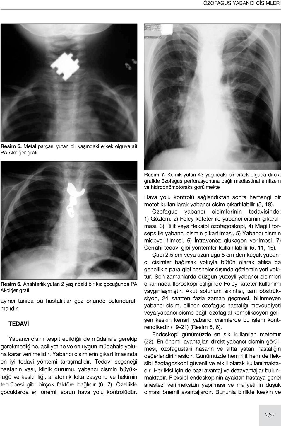 Anahtarlık yutan 2 yaşındaki bir kız çocuğunda PA Akciğer grafi ayırıcı tanıda bu hastalıklar göz önünde bulundurulmalıdır.