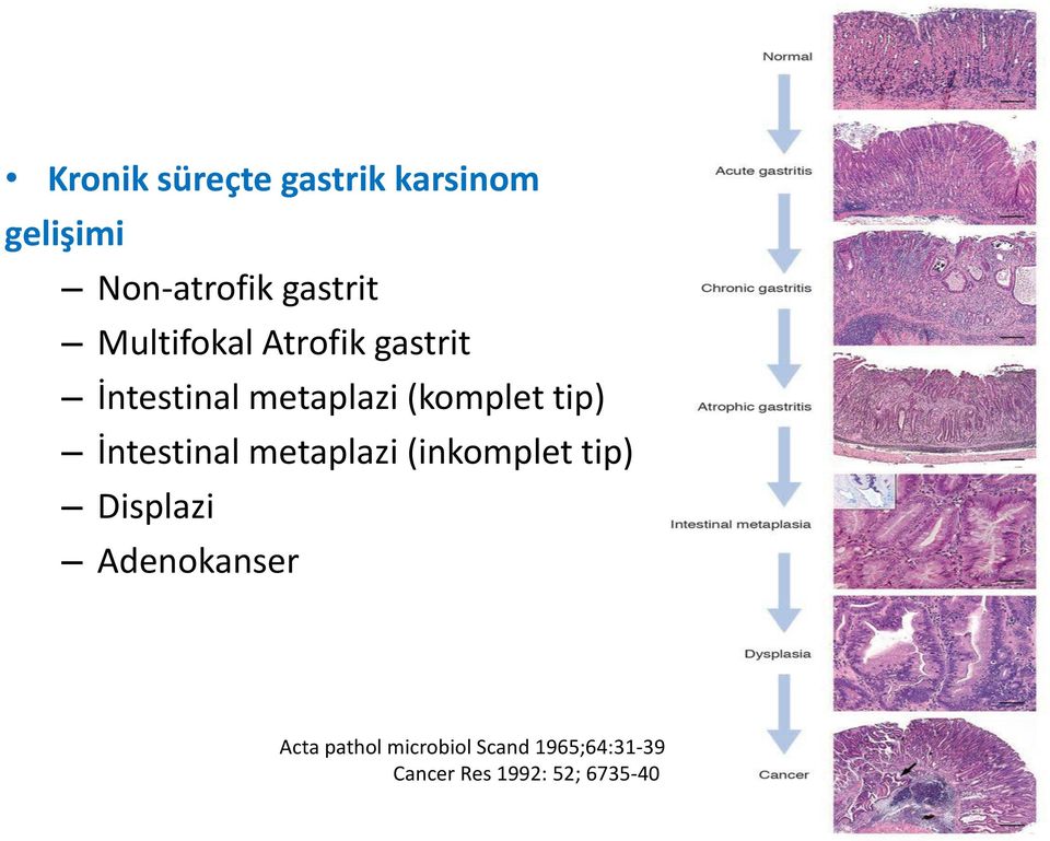 İntestinal metaplazi (inkomplet tip) Displazi Adenokanser Acta