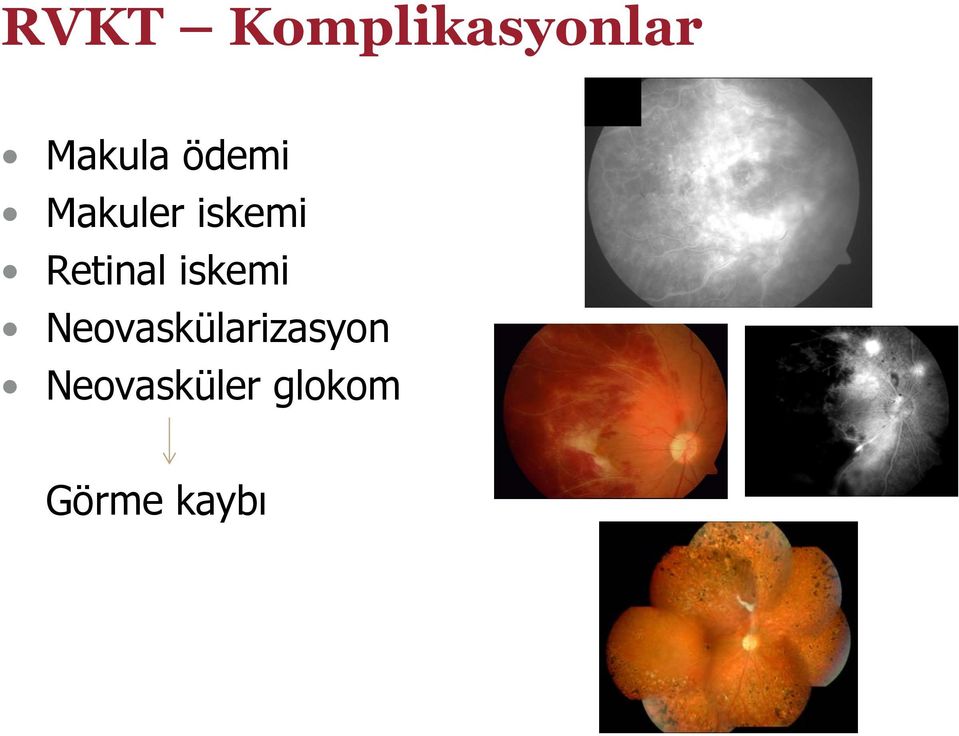 iskemi Neovaskülarizasyon