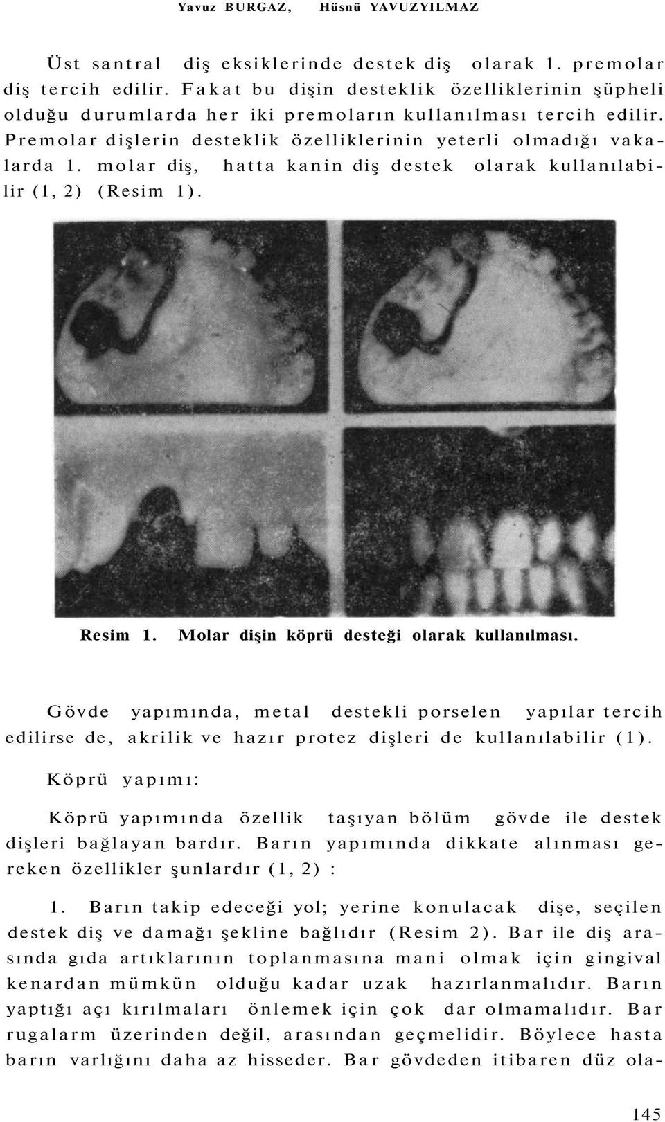 molar diş, hatta kanin diş destek olarak kullanılabilir (1, 2) (Resim 1). Resim 1. Molar dişin köprü desteği olarak kullanılması.