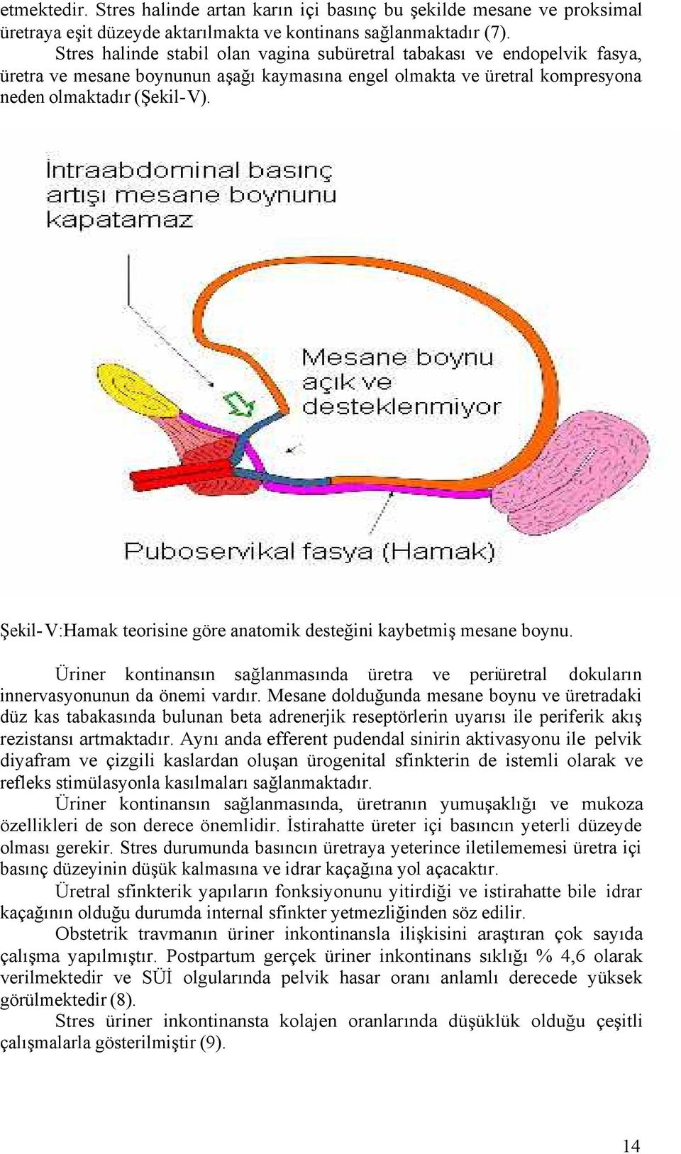 Şekil-V:Hamak teorisine göre anatomik desteğini kaybetmiş mesane boynu. Üriner kontinansın sağlanmasında üretra ve periüretral dokuların innervasyonunun da önemi vardır.