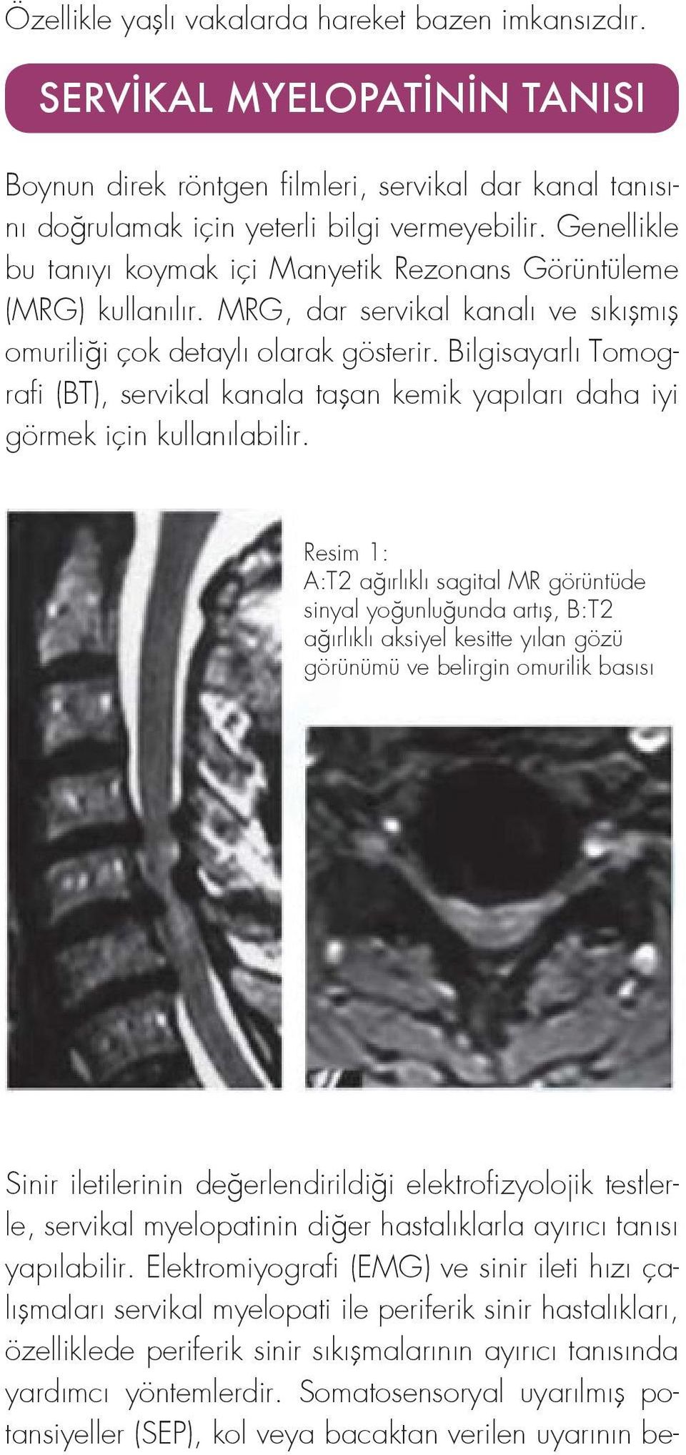 Bilgisayarlı Tomografi (BT), servikal kanala taşan kemik yapıları daha iyi görmek için kullanılabilir.