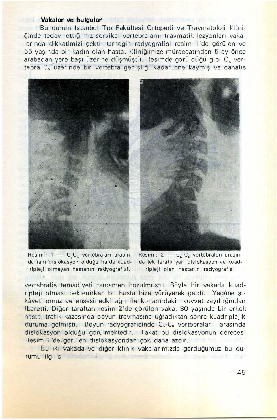 vertebra C;"üzerinde bir- vertebra' genişliği 'kadar' öne kaymış ve canalis Resim': 1 - C.