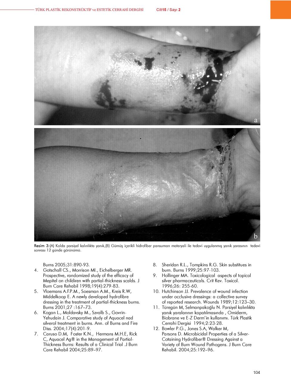 J Burn Care Rehabil 18;1(4):7-8.. Vloemans A.F.P.M., Soesman A.M., reis R.W, Middelkoop. A newly developed hydrofibre dressing in the treatment of partial-thickness burns. Burns 001;7 :167 7. 6.