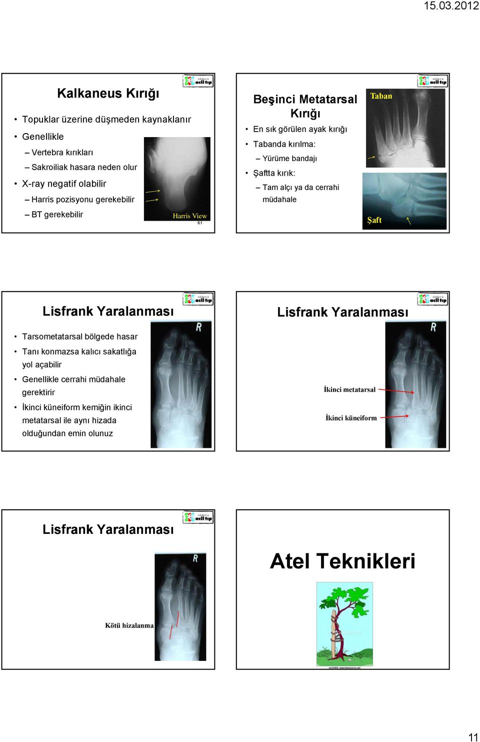 View 61 Şaft 62 Lisfrank Yaralanması Lisfrank Yaralanması Tarsometatarsal bölgede hasar Tanı konmazsa kalıcı sakatlığa yol açabilir Genellikle cerrahi müdahale gerektirir