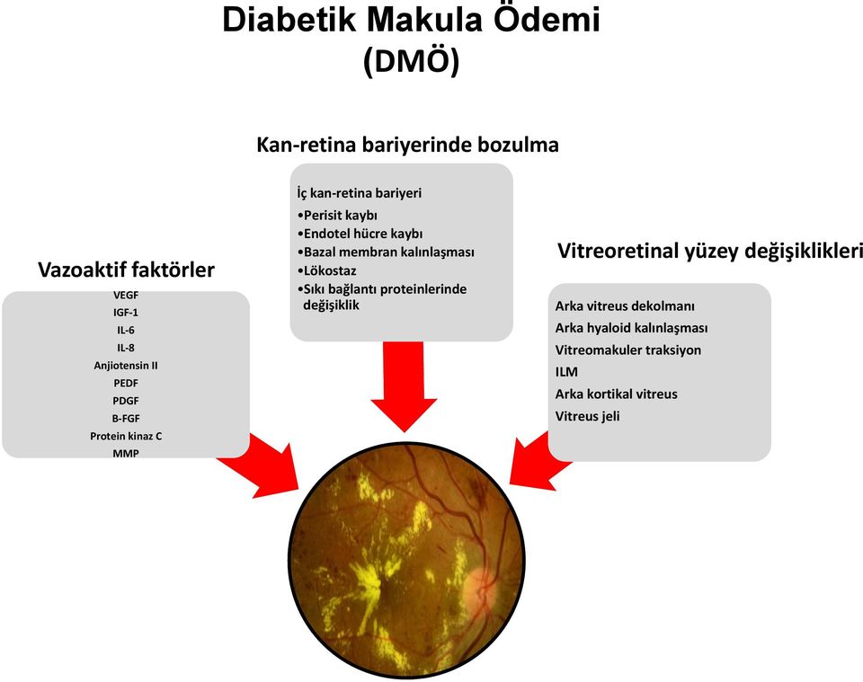 Bazal membran kalınlaşması Lökostaz Sıkı bağlantı proteinlerinde değişiklik Vitreoretinal yüzey