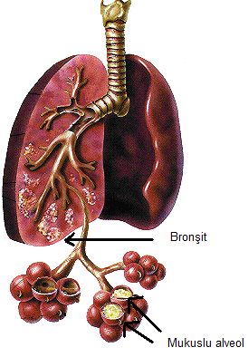 Siyanoz, Hırıltılı solunum ve solunum güçlüğü vardır. Resim 2.1: BronĢitli akciğer Komplikasyonlar Amfizem, (alveollerin geniģlemesi) BronĢektazi(bronĢların geniģlemesi)dir.