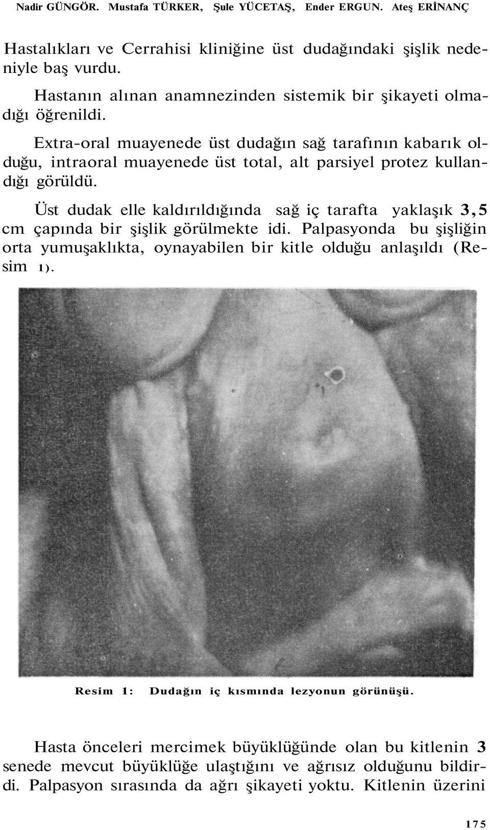 Extra-oral muayenede üst dudağın sağ tarafının kabarık olduğu, intraoral muayenede üst total, alt parsiyel protez kullandığı görüldü.