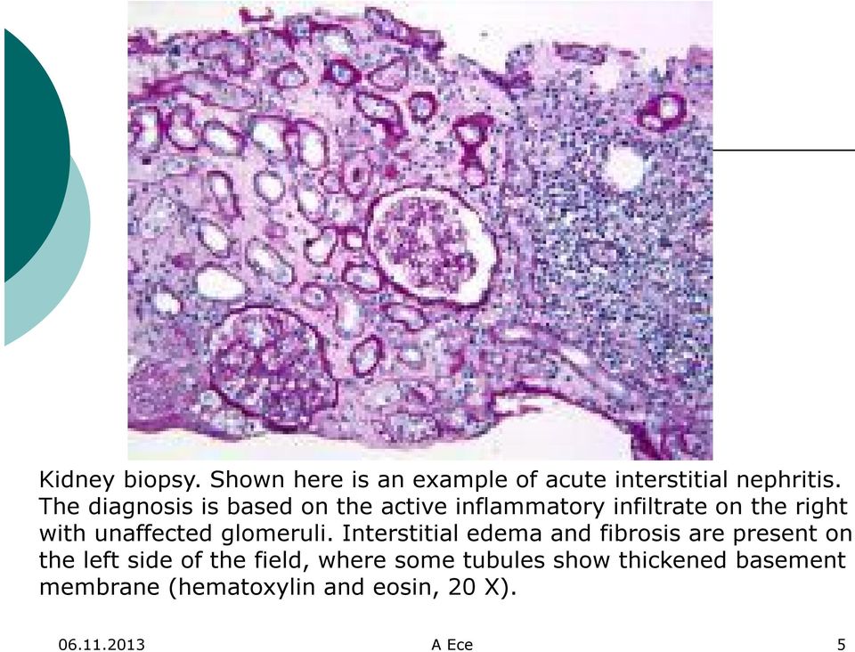 unaffected glomeruli.