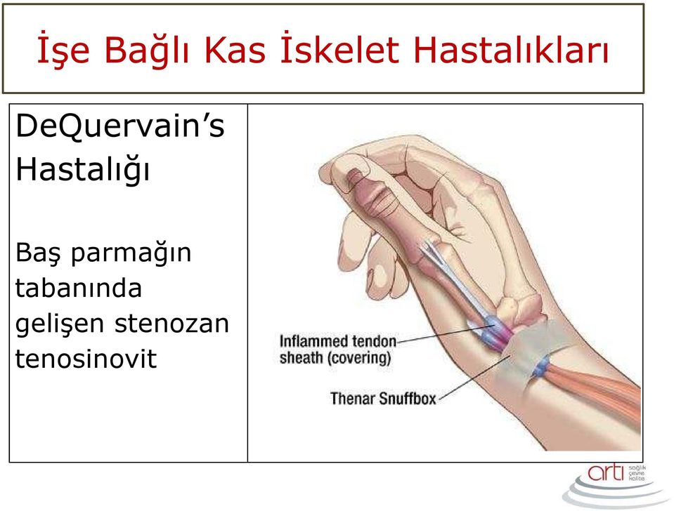 Hastalığı Baş parmağın Baş