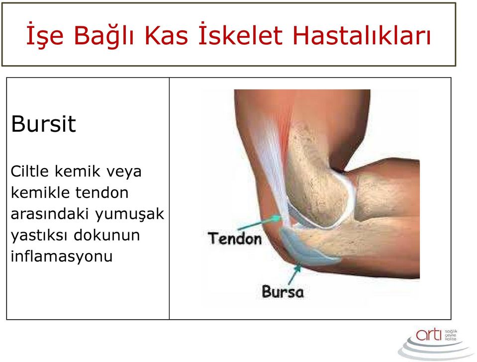 kemik veya kemikle tendon