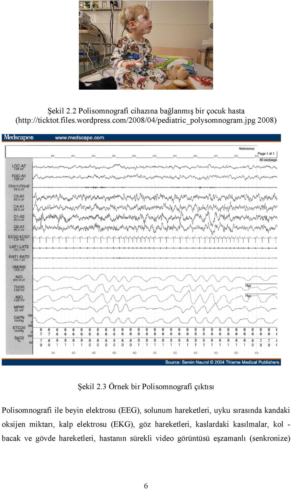 3 Örnek bir Polisomnografi çıktısı Polisomnografi ile beyin elektrosu (EEG), solunum hareketleri, uyku