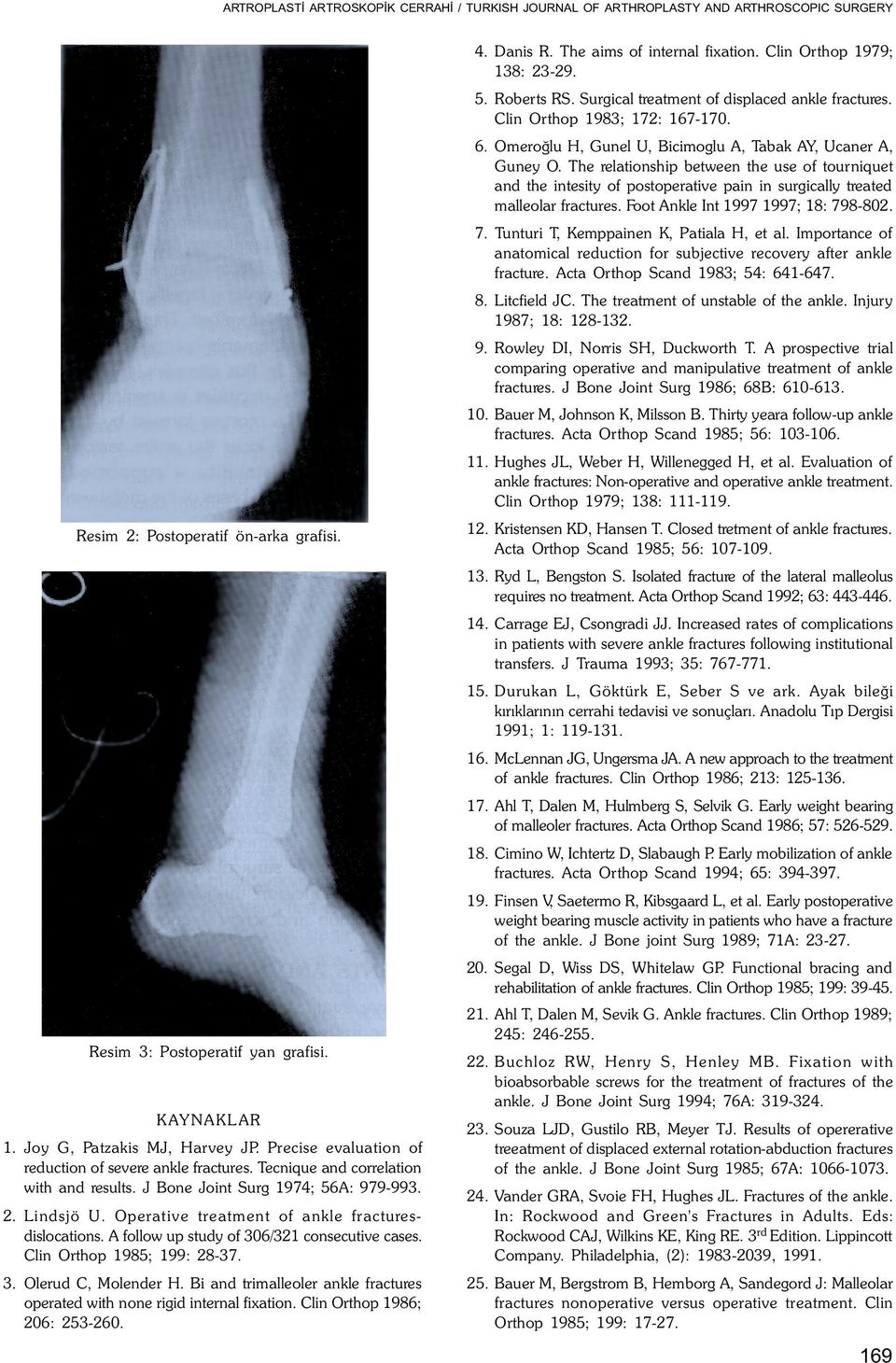 Clin Orthop 1985; 199: 28-37. 3. Olerud C, Molender H. Bi and trimalleoler ankle fractures operated with none rigid internal fixation. Clin Orthop 1986; 206: 253-260. 4. Danis R.