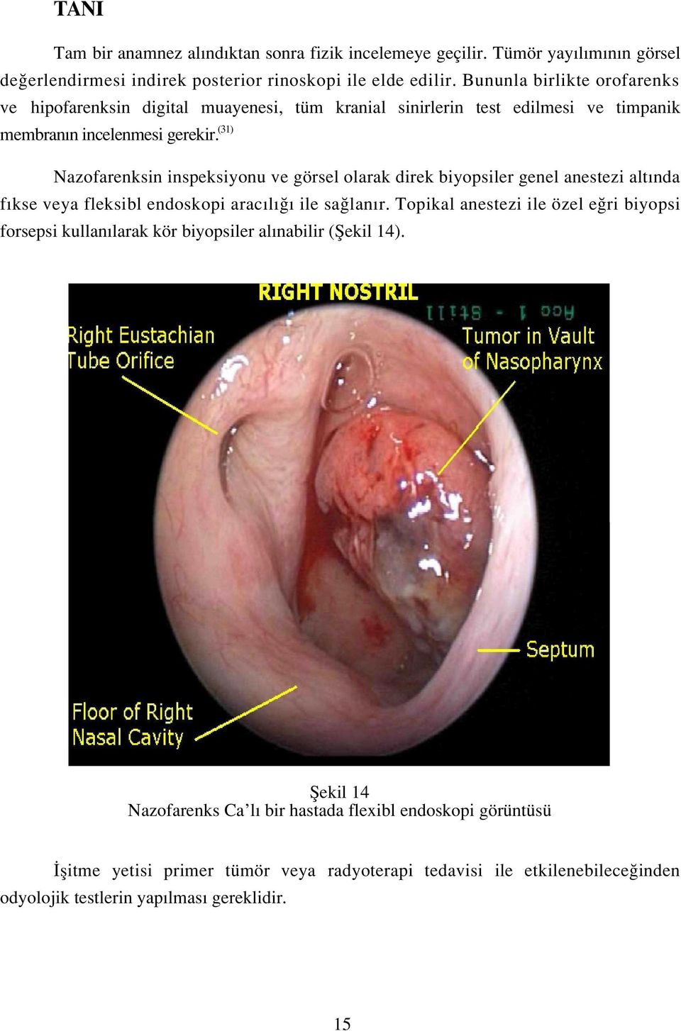 (31) Nazofarenksin inspeksiyonu ve görsel olarak direk biyopsiler genel anestezi alt nda f kse veya fleksibl endoskopi arac l ile sa lan r.