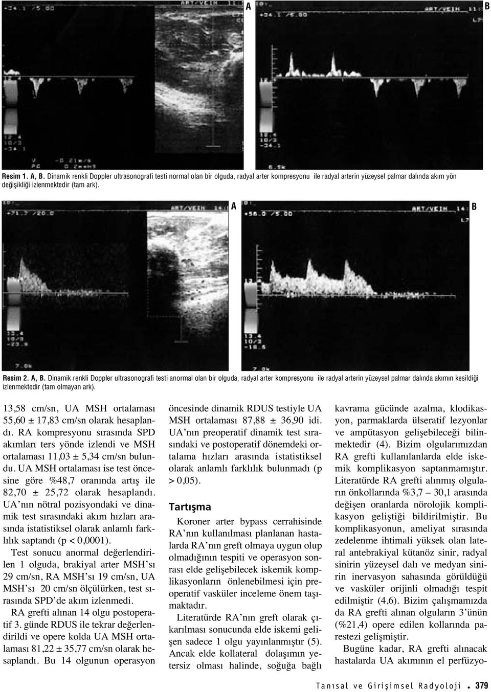 Dinamik renkli Doppler ultrasonografi testi anormal olan bir olguda, radyal arter kompresyonu ile radyal arterin yüzeysel palmar dal nda ak m n kesildi i izlenmektedir (tam olmayan ark).