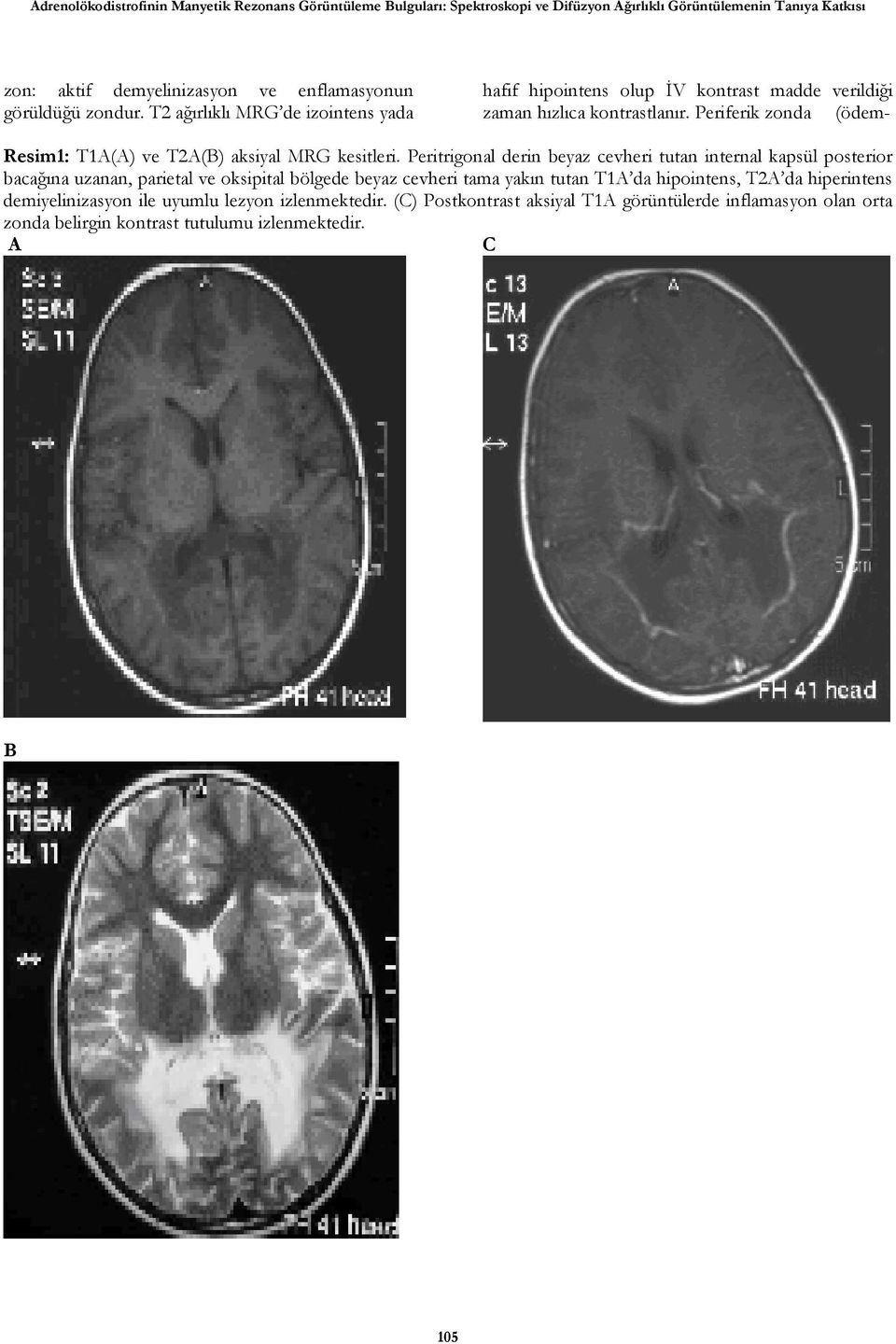 Periferik zonda (ödem- Resim1: T1() ve T2() aksiyal MRG kesitleri.