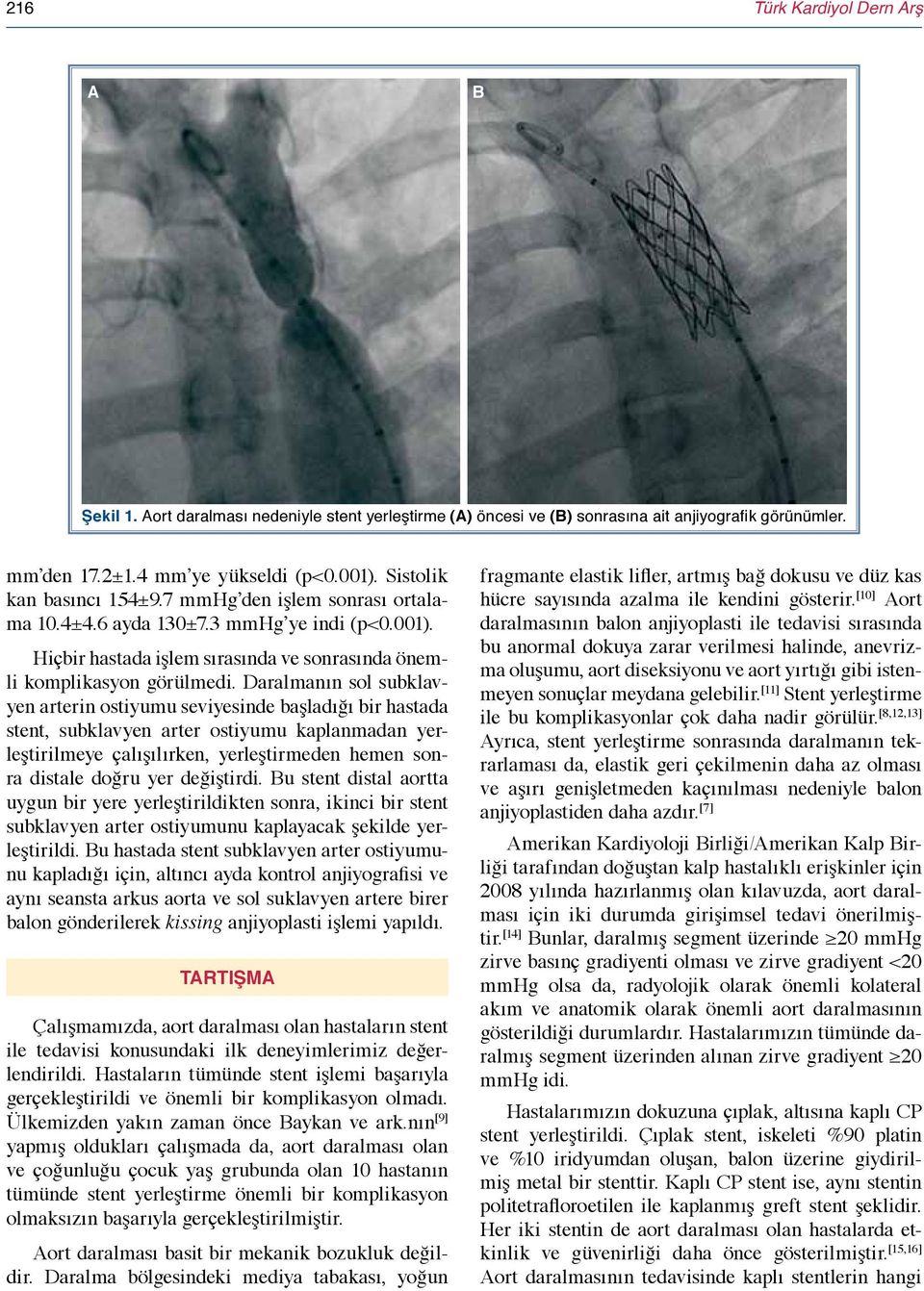 Daralmanın sol subklavyen arterin ostiyumu seviyesinde başladığı bir hastada stent, subklavyen arter ostiyumu kaplanmadan yerleştirilmeye çalışılırken, yerleştirmeden hemen sonra distale doğru yer