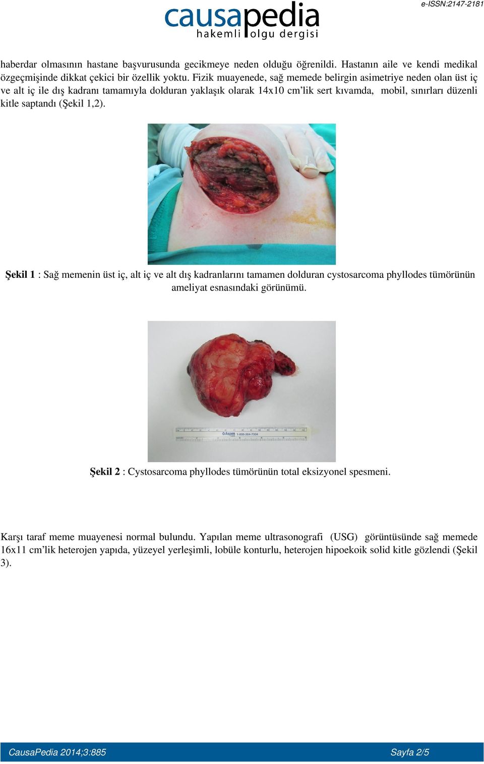 (Şekil 1,2). Şekil 1 : Sağ memenin üst iç, alt iç ve alt dış kadranlarını tamamen dolduran cystosarcoma phyllodes tümörünün ameliyat esnasındaki görünümü.