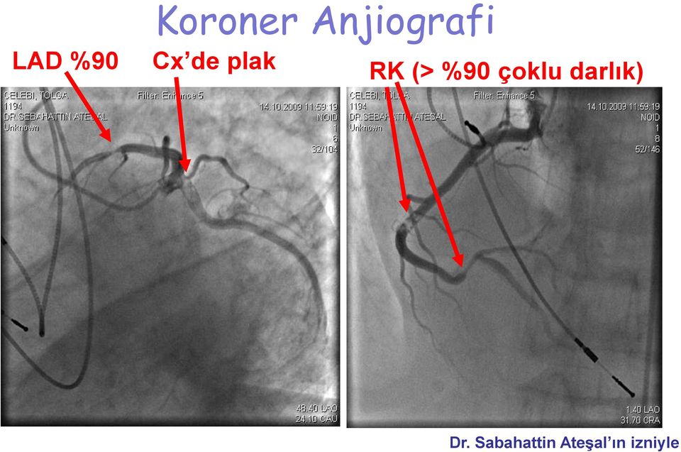 %90 çoklu darlık) Dr.