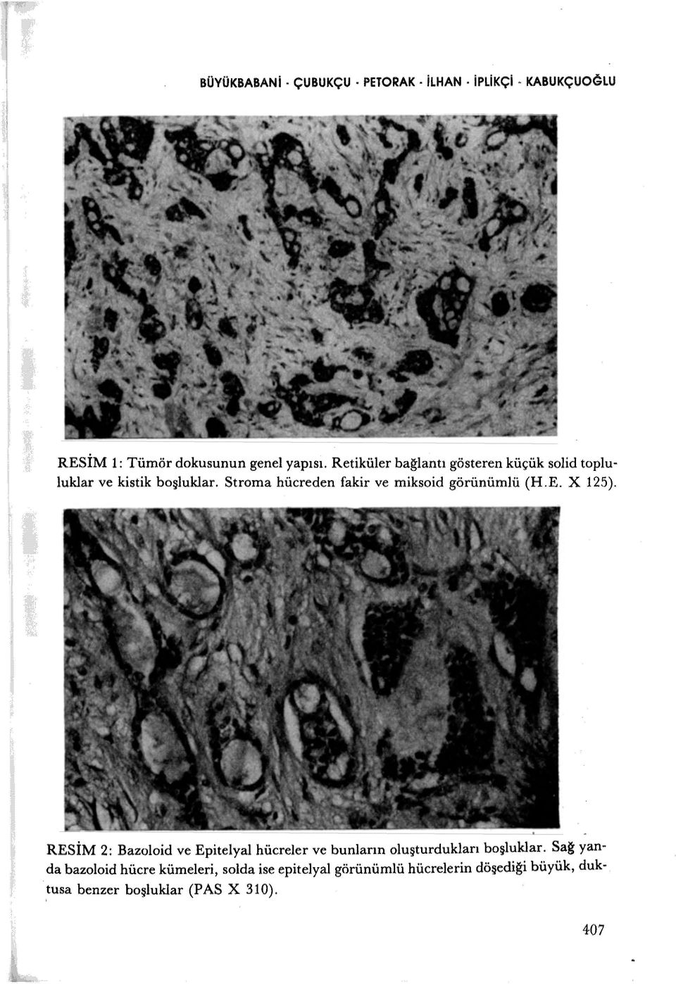 Stroma hücreden fakir ve miksoid görünümlü (H.E. X 125).